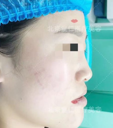 我在北京童仁整形假体垫鼻基底前后对比照,法令纹真变浅了!