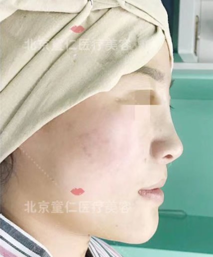 我在北京童仁整形假体垫鼻基底前后对比照,法令纹真变浅了!