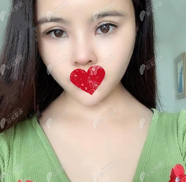 彤美李长赋医生鼻综合术后照