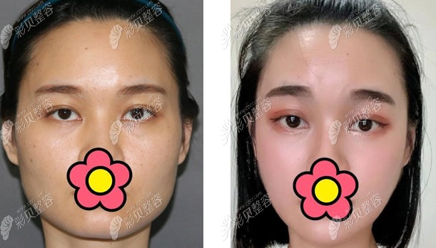 张笑天颧弓内推和下颌角截骨案例