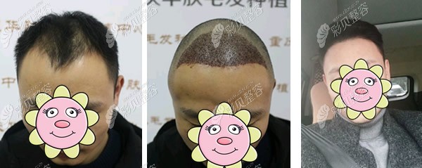 重庆华肤医院男生种植发际线10个月效果