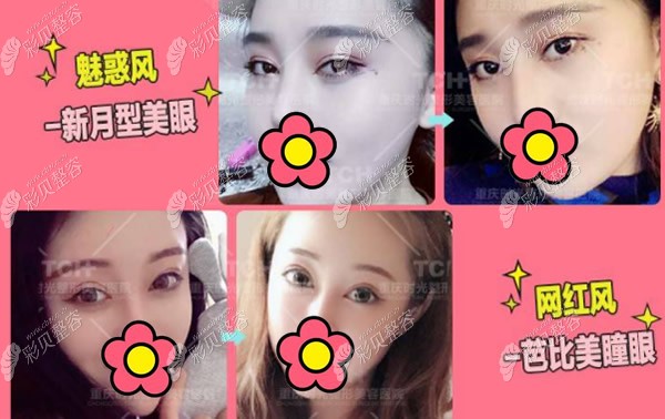 重庆时光整形医院孔令杰医生打造的眼综合案例