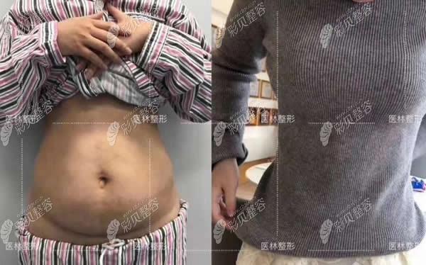新罗佰蓓医林整形汪骄霸腰腹吸脂术前后对比照