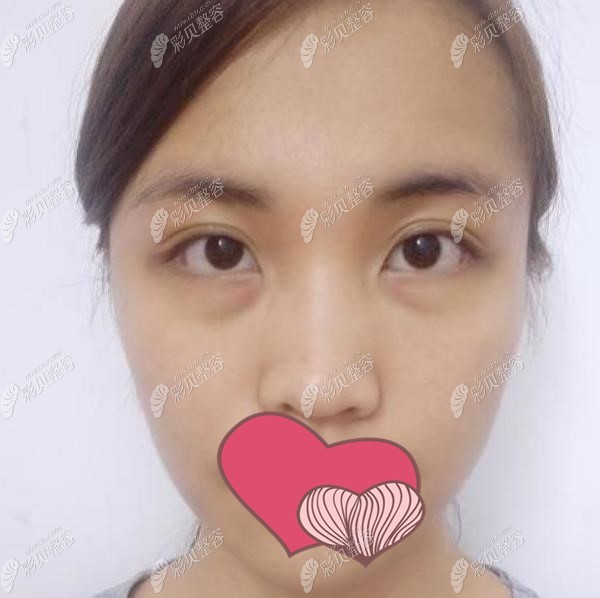 上饶韩美整形童晓江医生内切祛眼袋术前