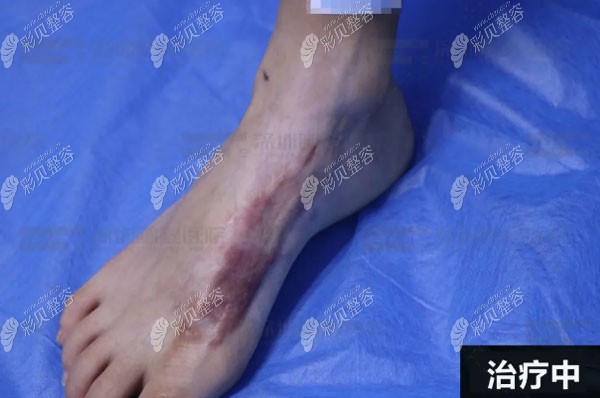 治疗增生疤痕一个月的恢复效果图