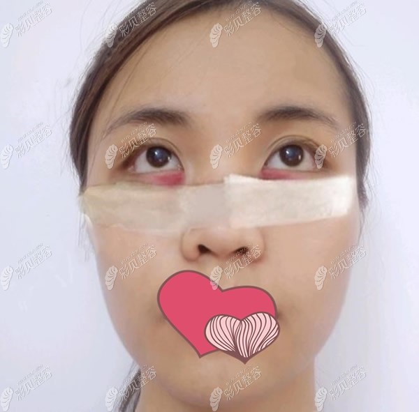 上饶童晓江医生祛眼袋内切术后第二天