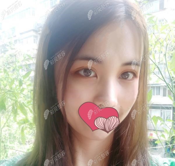 韩美整形童晓江医生内路去眼袋术后第八天