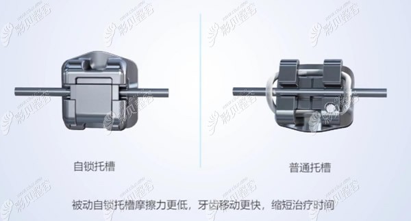 自锁托槽与普通托槽的区别