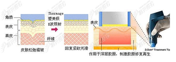 水剥离和热玛吉区别