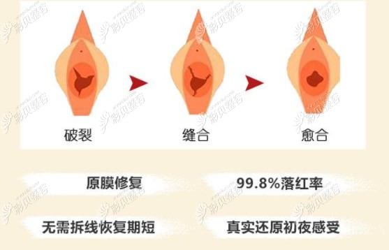 聊城韩美处女膜修补手术效果怎么样