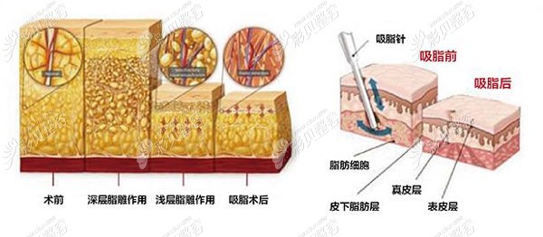 刘伟峰医生的吸脂技术优势