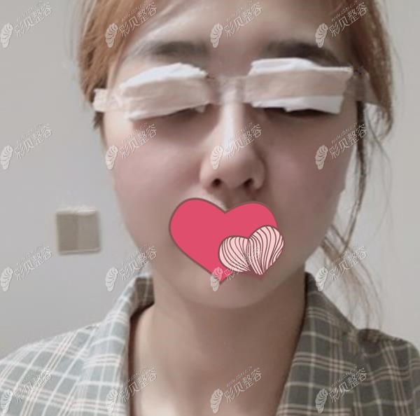 吉林杨雯淇医生割双眼皮第1天照片