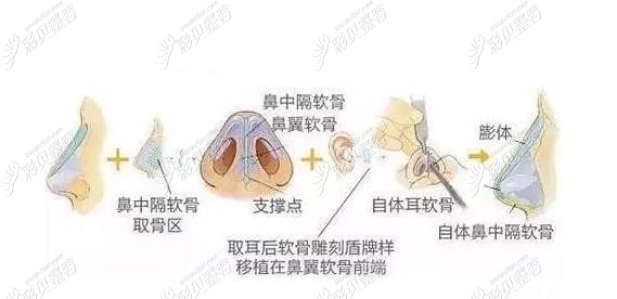 隆鼻手术过程图