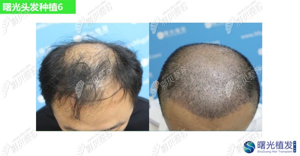 地中海O型脱发在曙光种植头发20天恢复去