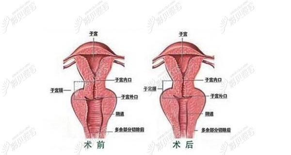 激光缩阴和手术缩阴哪个效果好做菲蜜丽激光一次效果咋样