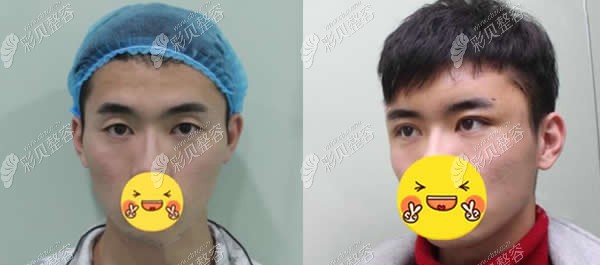 洛阳孔繁荣整形周先华双眼皮术前后对比照片
