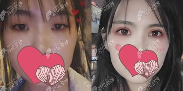 洛阳毛大夫整形普潇医生双眼皮案例图