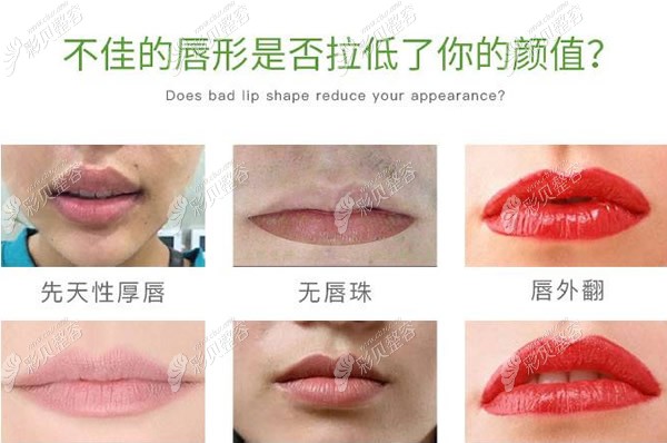 安庆市厚唇改薄整形手术价格一般要多少钱,7天能恢复自然吗