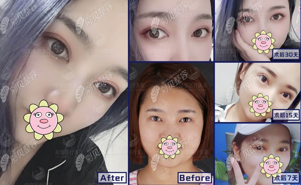内双妹子在北京米兰柏羽丽都做8mm全切双眼皮第7天,15天,30天宽度对比