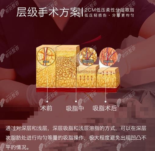 哈尔滨超龙整形吸脂术前术后变化图