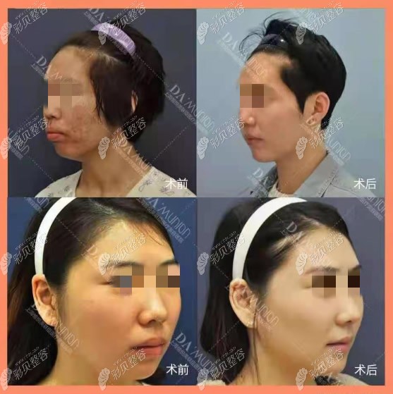 案例:上海美联臣医院骨性凸嘴矫正前后对比照片+脸型变化图