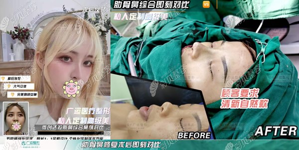 魏广运医生打造的肋骨鼻综合对比照片