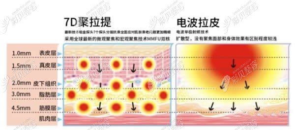 7d聚拉提和电波拉皮的区别