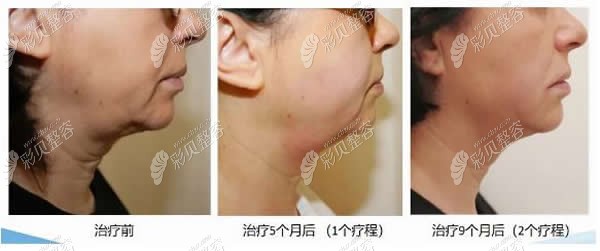 7d聚拉提术前和术后9个月变化过程图