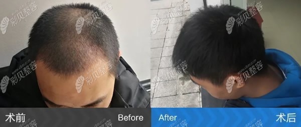 男生m型脱发在碧莲盛种植2000毛囊前后对比照片