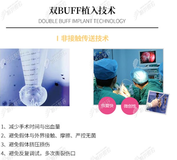 曹孟君医生隆胸假体植入速度快