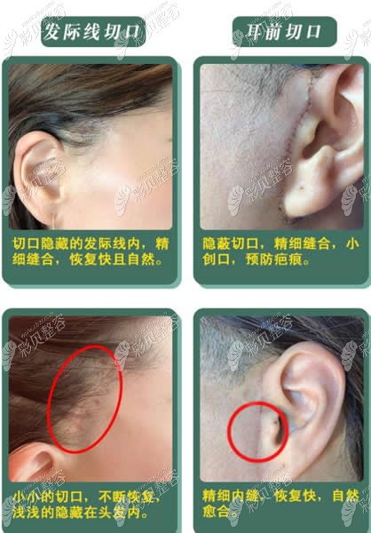 广运小切口手术发际线和耳前切口恢复图