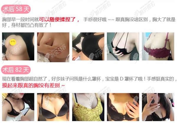 软窥镜隆胸术后评价