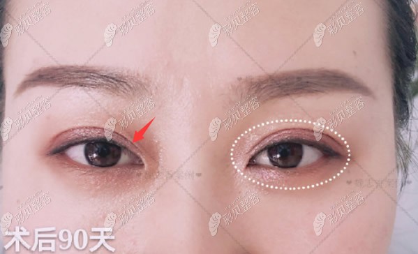 北京丽星医美医院魏志香医生做的平扇双眼皮案例