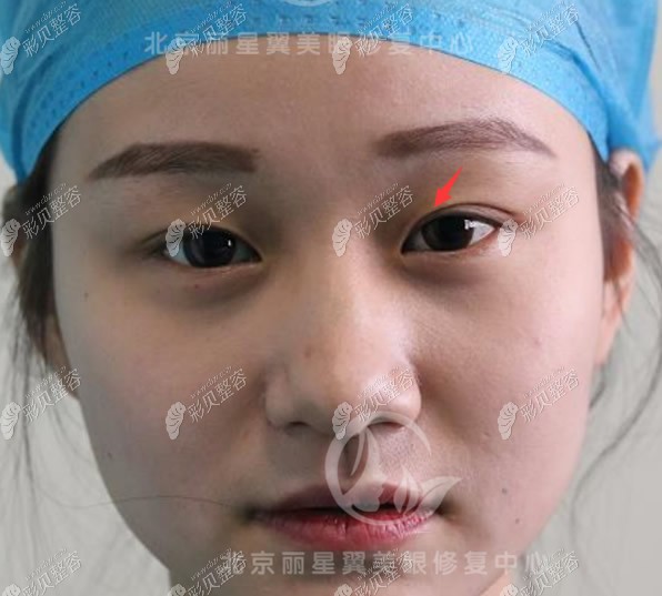 北京丽星翼美医院自然开扇双眼皮效果图