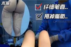 在天津坤如玛丽医院做大腿360环形吸脂后腿细了好多(附视频)
