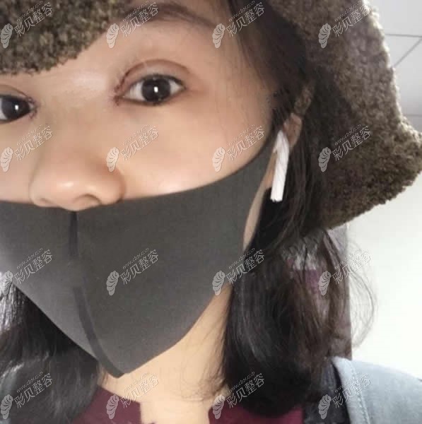 北京领医医美无痕双眼皮术后第3天