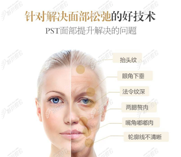 pst面部提升能解决哪些衰老问题