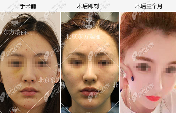 北京李晓东医生做pst面部提升前后图片