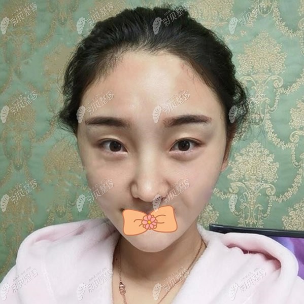 西安米兰柏羽面部埋线提升术后3天照