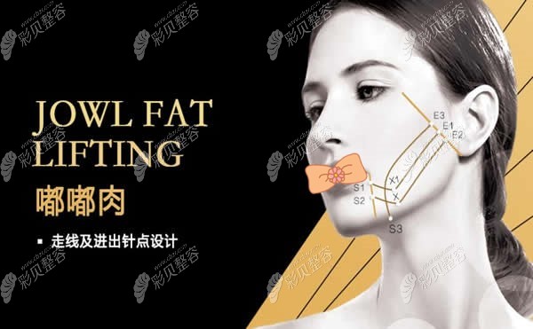 埋线提升去嘟嘟肉走线图