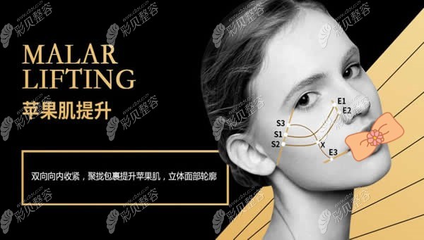 苹果肌埋线提升布线图