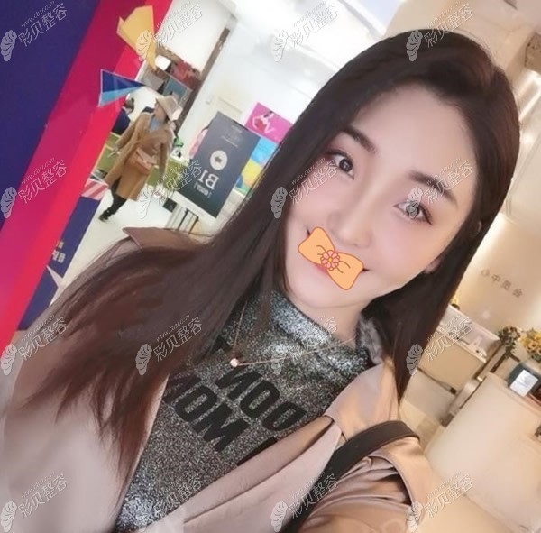 米兰柏羽埋线提升术后半个月恢复图