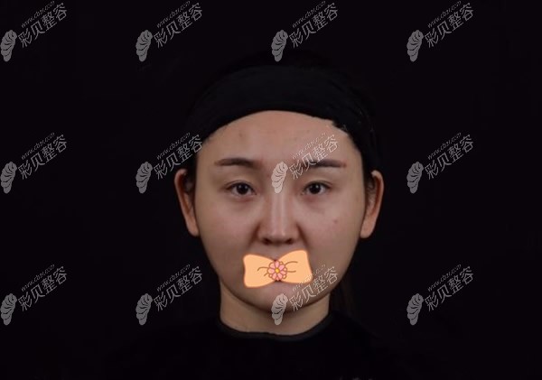 去西安米兰伯做埋线提升术前照