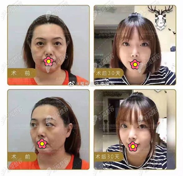 北京做pst面部提升前后的对比图片