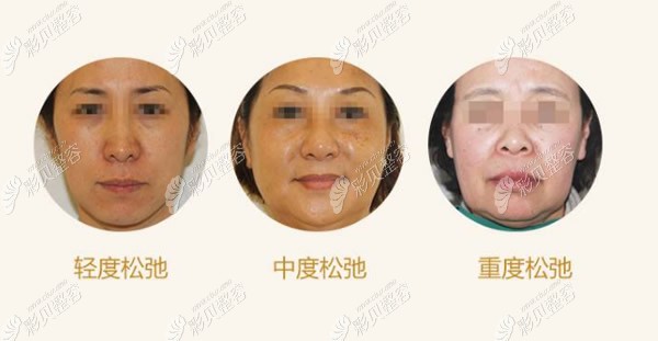 轻度中度重度皮肤松弛的区别