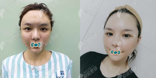 郭同荣医生自体脂肪填充全脸术后即刻和20天对比照