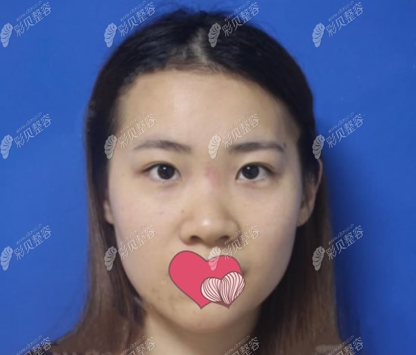 在芜湖壹加壹做半肋骨鼻综合3-6个月恢复期中,山根的变化图