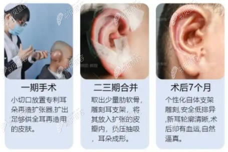 全包法耳朵再造手术过程