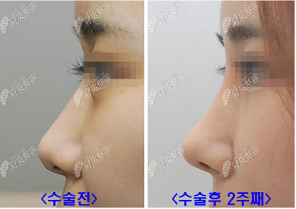 郑灿宇院长射极峰膨体垫鼻梁+耳软骨垫鼻尖两个月照片