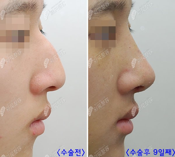 韩国姿飞整形男生驼峰鼻矫正9个月恢复图